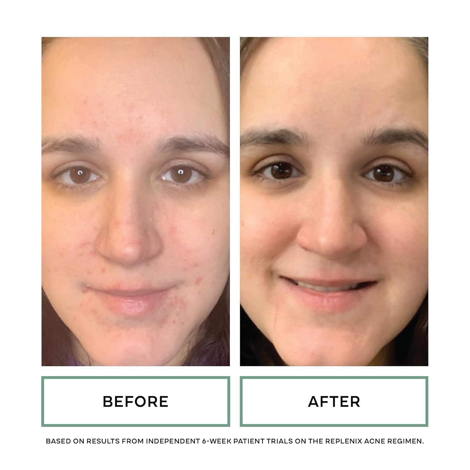 image:imageReplenix BP Acne Face Wash 67 Fl Oz NonOily Benzoyl Peroxide Facial Cleanser with MedicalGrade Ingredients for AcneProne Skin Gently Unclogs amp Refines Pores NonDrying amp NonIrritating5 Benzoyl Peroxide