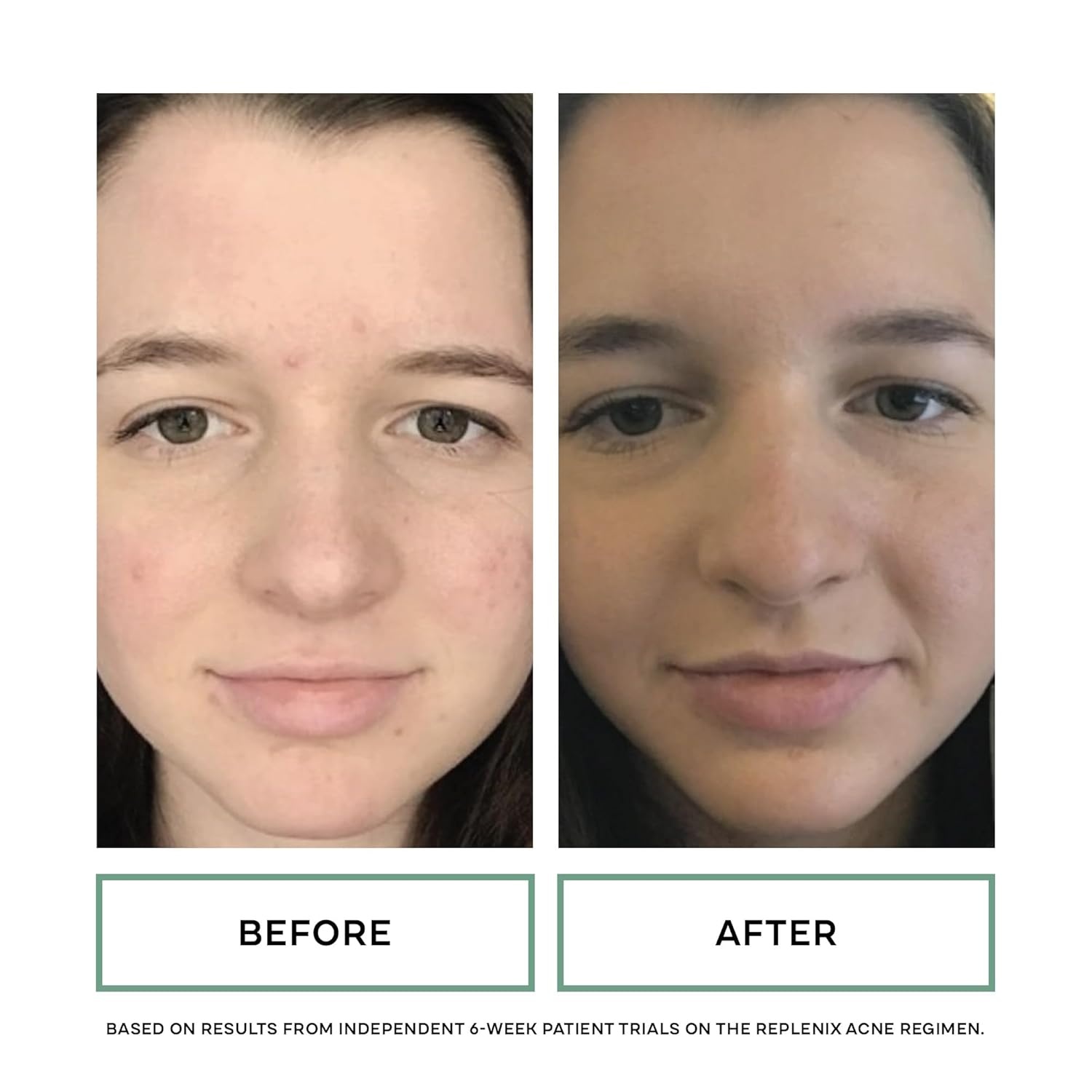 image:imageReplenix GlySal Deep Pore Facial Cleanser MedicalGrade 5 Glycolic amp 2 Salicylic Acid OilFree Face Wash for AcneProne Skin 67 fl oz5 Glycolic Acid