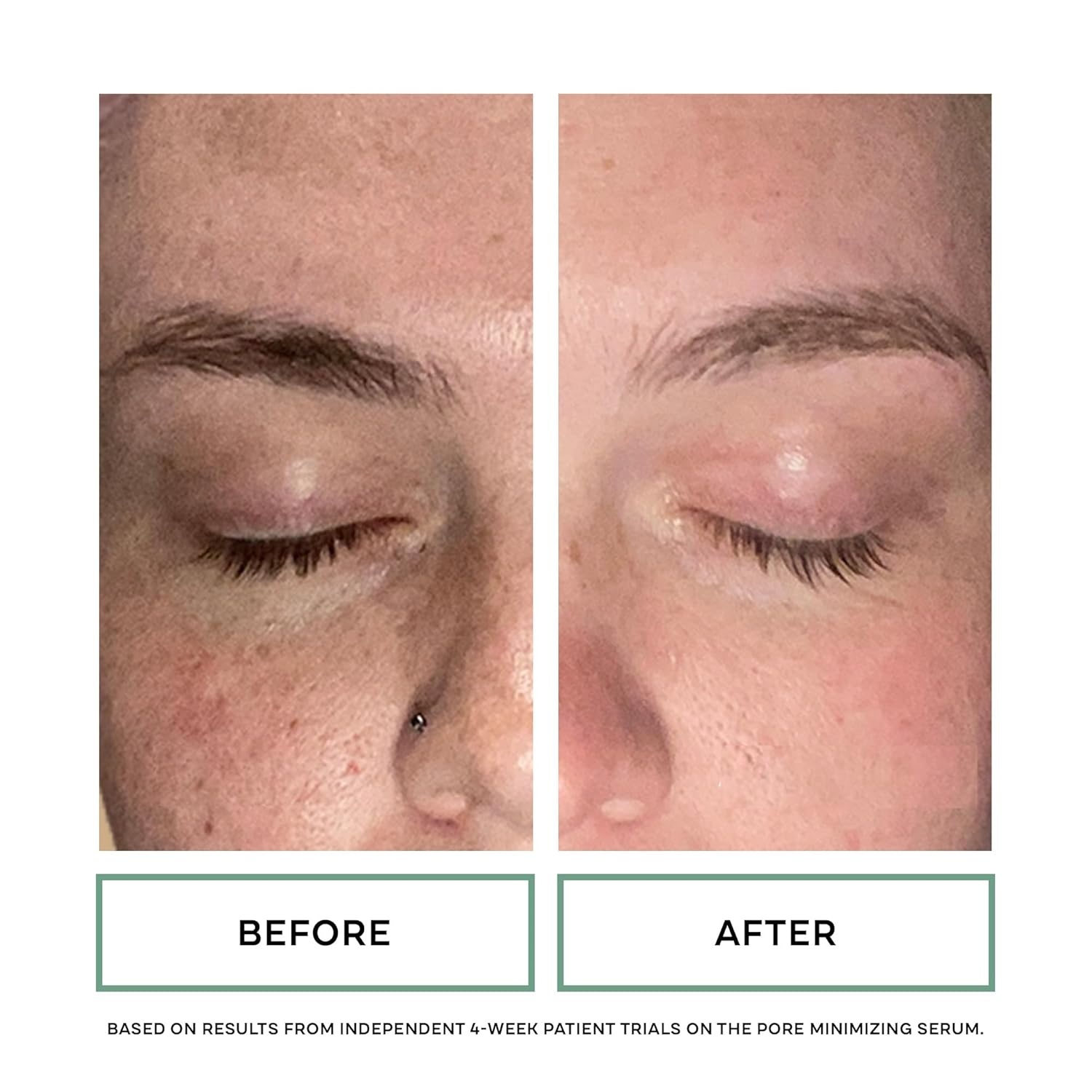image:imageReplenix Pore Minimizing Face Serum with MedicalGrade Niacinamide Lactic amp Salicylic Acids DermatologistRecommended for Large Pores amp Uneven Skin 1 fl oz